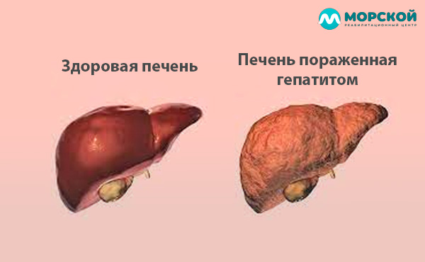 Сравнение здоровой и больной гепатитом печени Сравнение здоровой и больной гепатитом печени